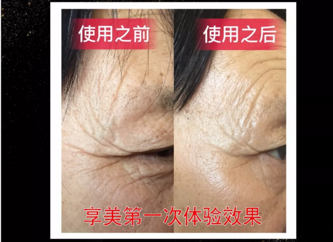 鄭州美博會_小黑瓶使用前后